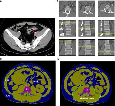 Evaluation of bone mineral density and body compositions interrelation in young and middle-aged male patients with Crohn’s disease by quantitative computed tomography